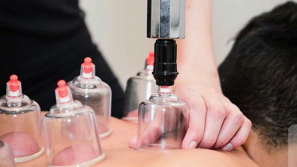 Cup4Sunnah - Cupping (Hijama) Clinic & Spinal Alignment | Acupuncture | Pain Management — photo 6