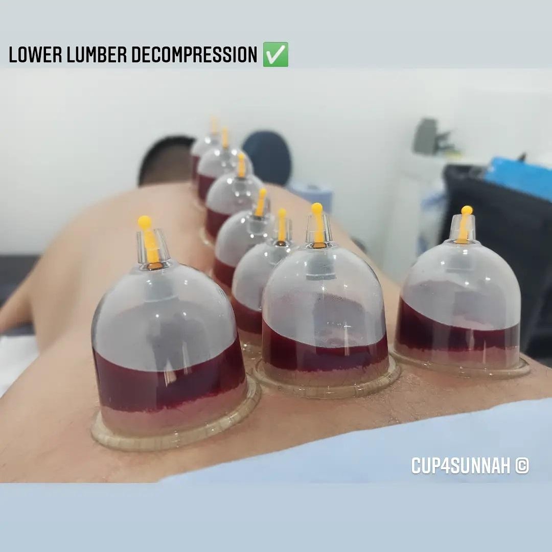 Cup4Sunnah - Cupping (Hijama) Clinic & Spinal Alignment | Acupuncture | Pain Management — photo 1