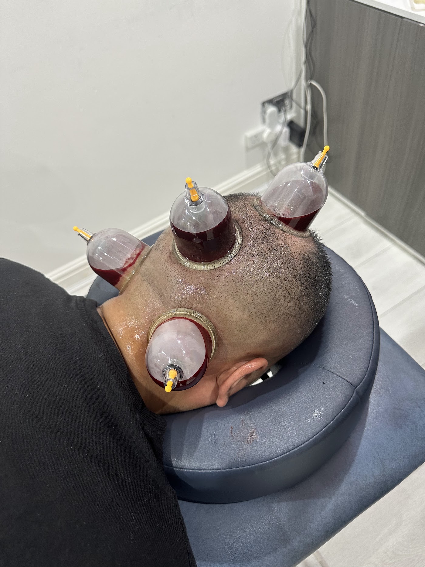 Cup4Sunnah - Cupping (Hijama) Clinic & Spinal Alignment | Acupuncture | Pain Management — photo 3
