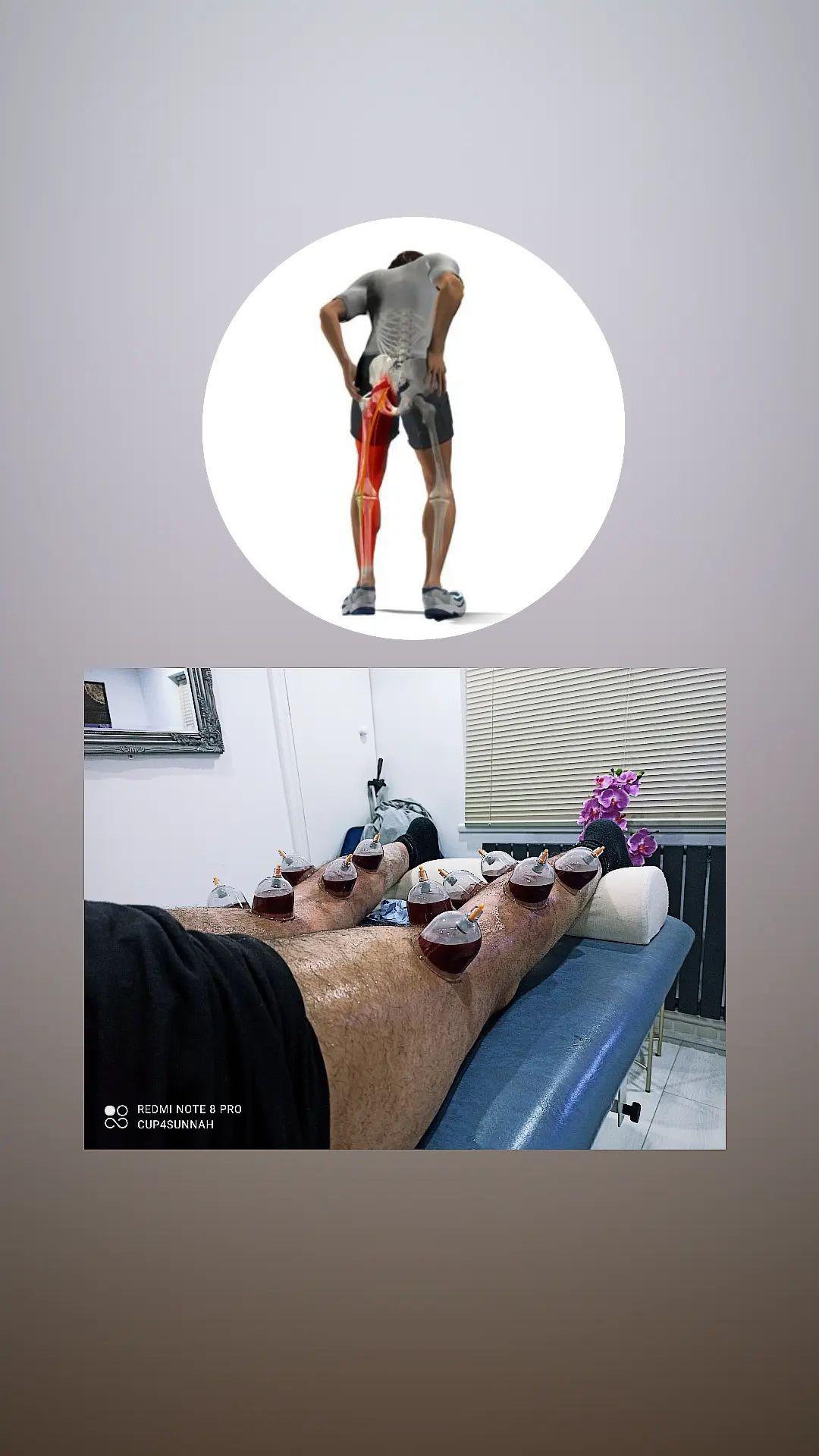 Cup4Sunnah - Cupping (Hijama) Clinic & Spinal Alignment | Acupuncture | Pain Management — photo 7